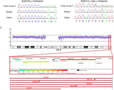 Prenatal Genetic Diagnosis in Three Fetuses With Left Heart Hypoplasia (LHH) From Three Unrelated Families